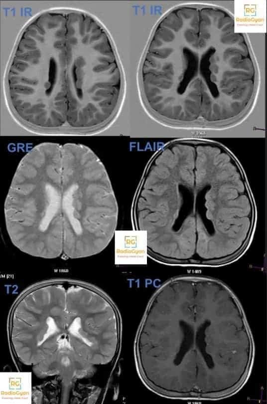 Subependymal heterotopia Radiology MRI images