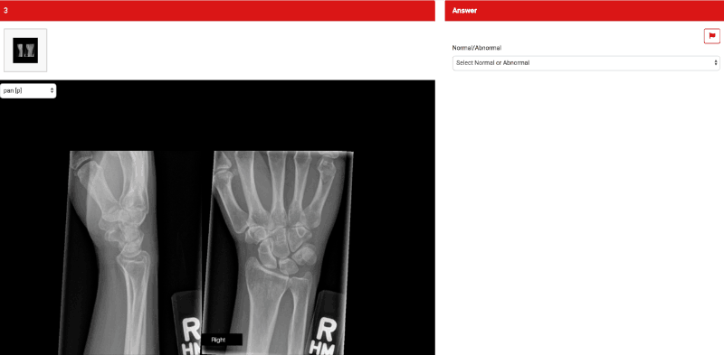 Radiograph of wrist as an example for Final FRCR rapid reporting
