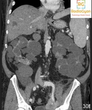 Autosomal Polycystic Kidney (ADPKD) CT
