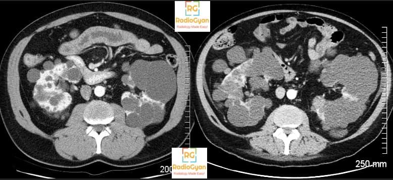 Autosomal Dominant Polycystic Kidney Total Kidney volume CT
