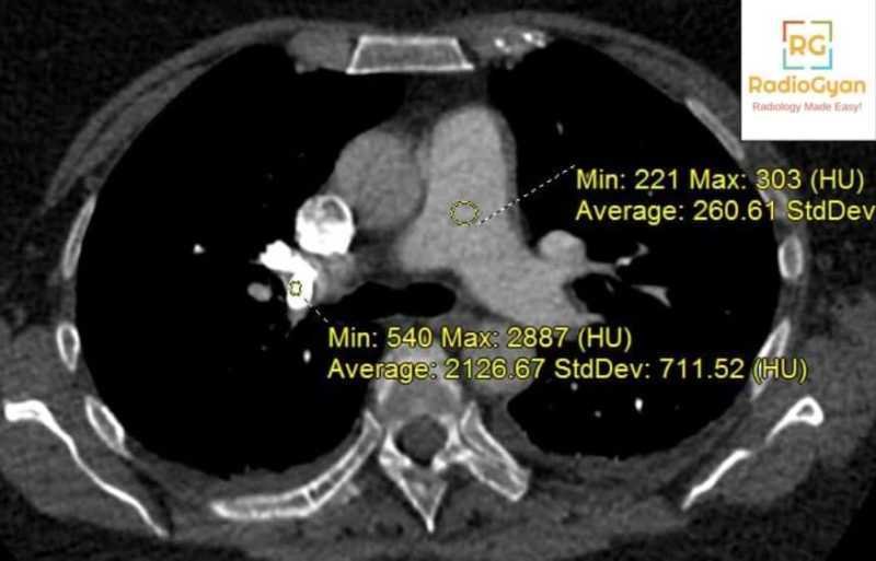 Pulmonary cement embolism after vertebroplasty axial CT with HU
