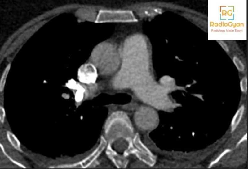 Pulmonary cement embolism after vertebroplasty axial CT