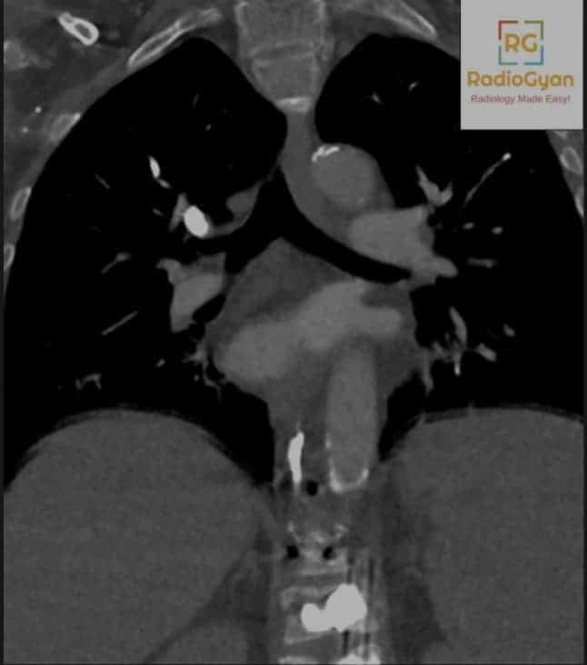 Pulmonary cement embolism after vertebroplasty coronal CT