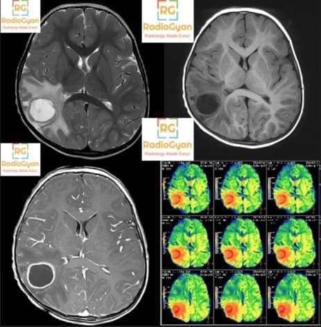 Neuroradiology Cases - RadioGyan.com