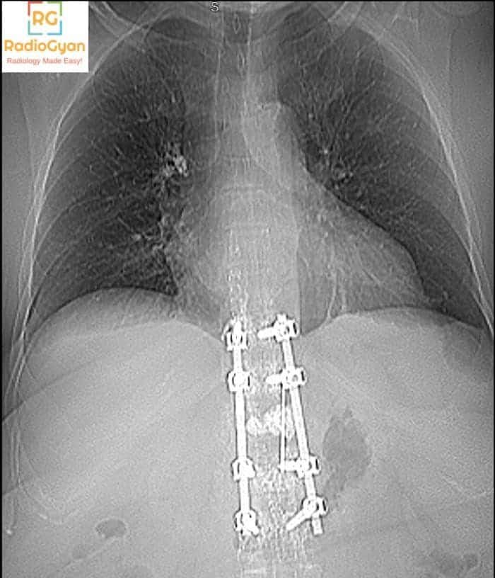 Plain chest radiograph showing hyperdense pulmonary cement embolism after vertebroplasty