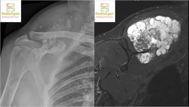 Chondrosarcoma Bone tumors radiology
