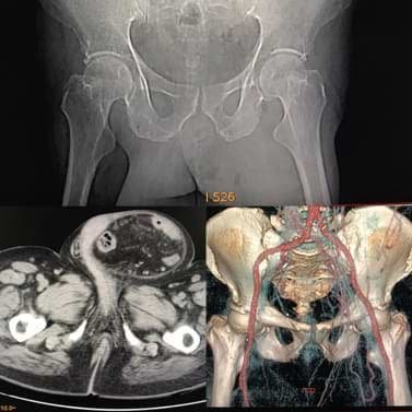 Inguinoscrotal hernia Radiology Cases Quiz RadioGyan