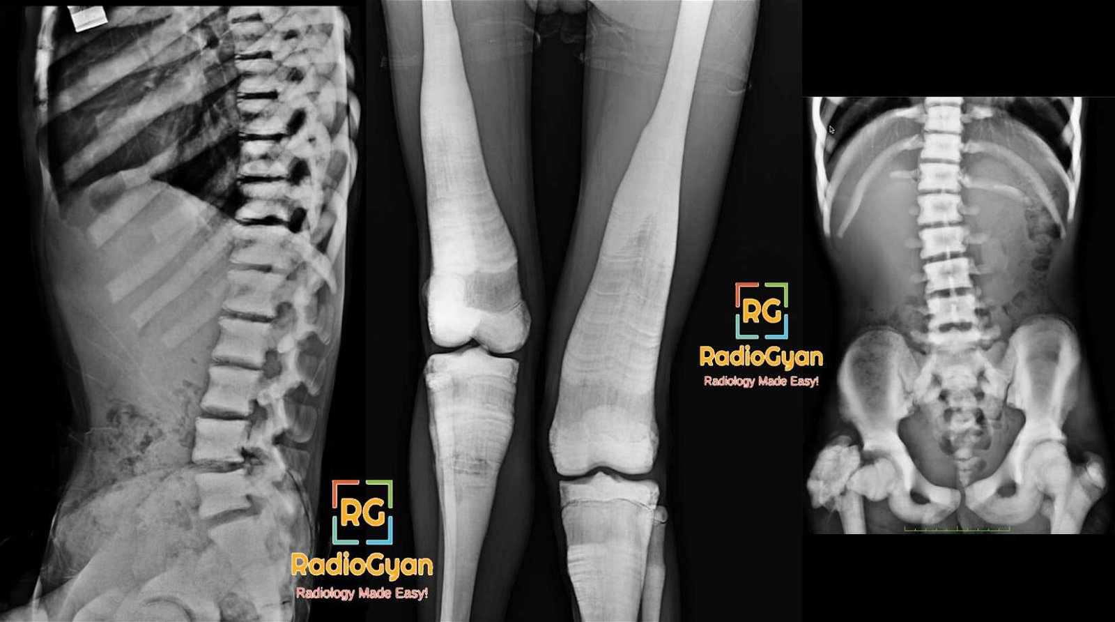 Radiograph showing osteopetrosis marble bone disease Albers-Schönberg disease interesting radiology case