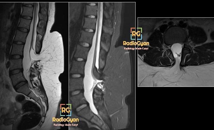 MSK MRI cases - Tethered cord with lipoma