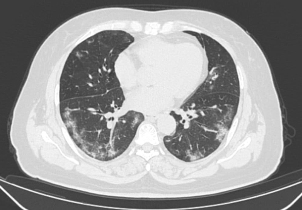 CT showing patchy ground-glass opacities in a patient with  COVID-19 pneumonia. 