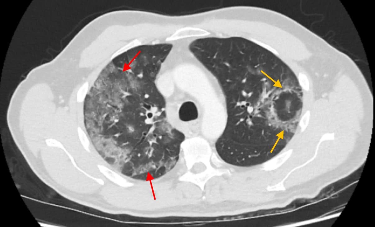 Coronavirus radiology CT imaging features