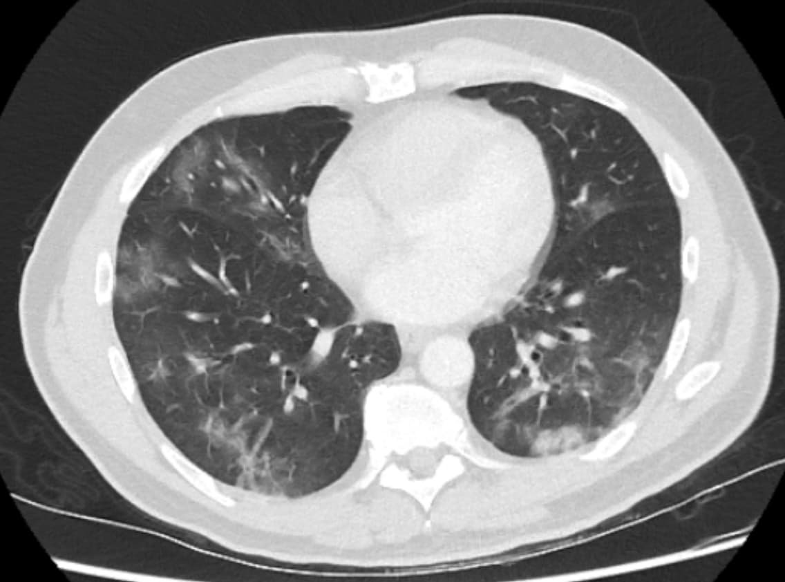 CT scan image of a patient with coronavirus pneumonia