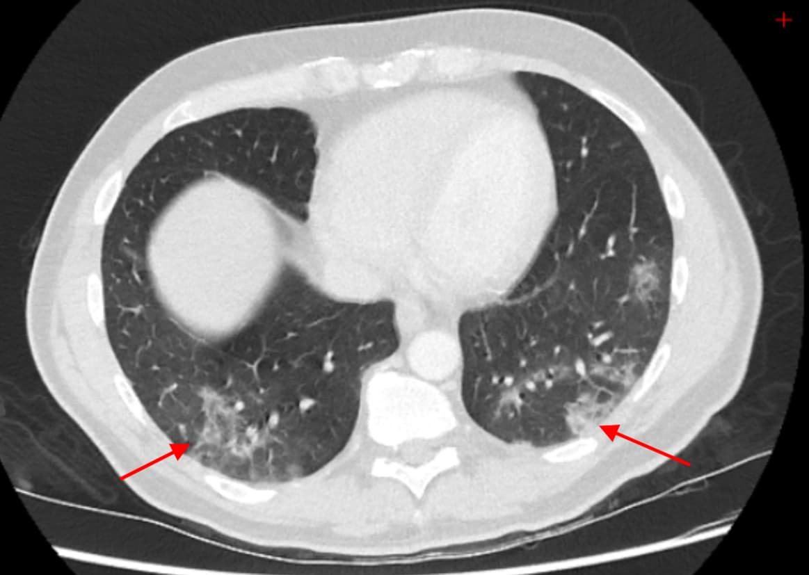 CT scan showing ground-glass opacities in a patient with COVID-19 pneumonia