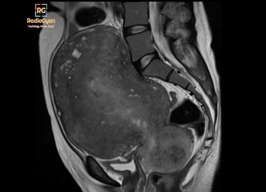 MRI T2W sagittal image of adenomyosis
