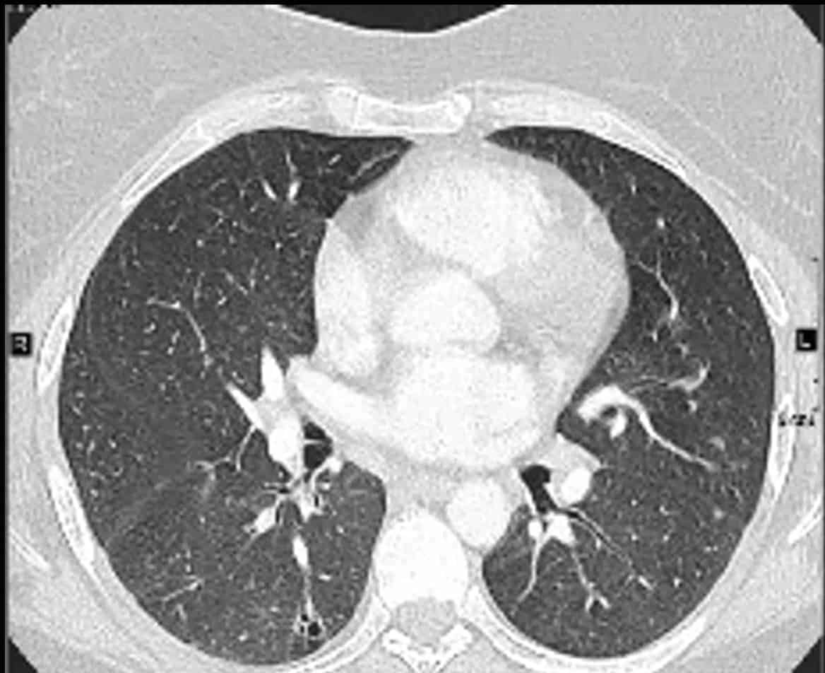 Pulmonary langerhans cell histiocytosis radiology CT features