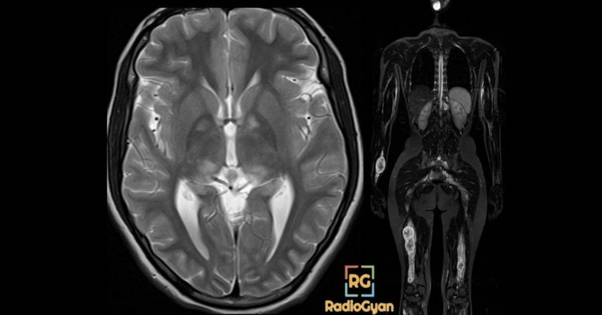 Neurofibromatosis Radiology Case