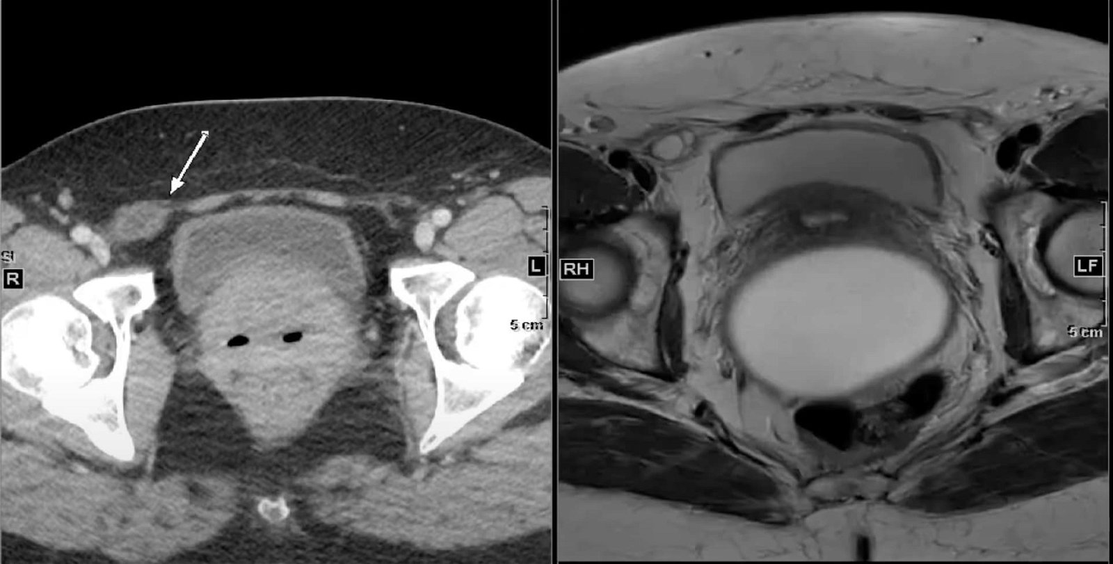 Canal of Nuck cyst MRI and CT