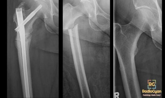 Radiograph of a patient with atypical Femoral Fracture