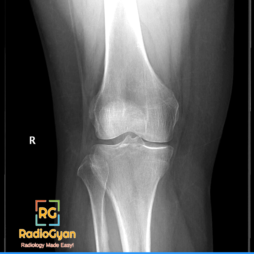 Tibial Plateau Fracture RadioGraph frontal view
