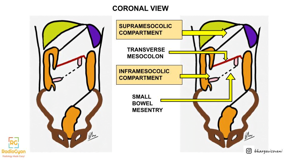 Coronal view of peritoneal compartments illustration
