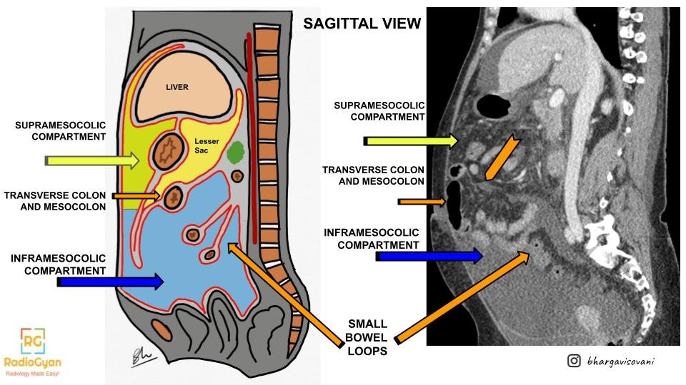 Sagittal view of peritoneal compartments illustration
