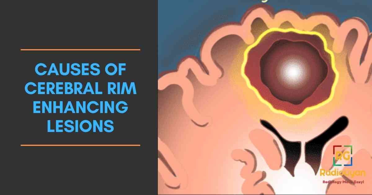 causes of Cerebral Rim Enhancing Lesions