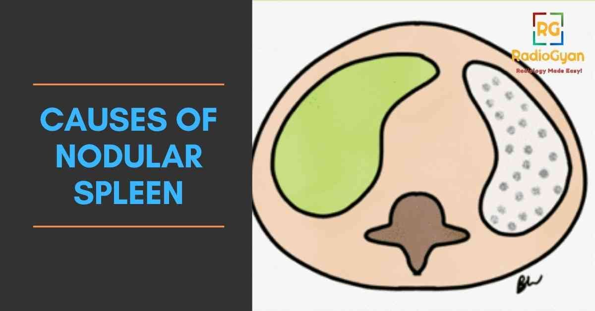 causes of Nodular Spleen