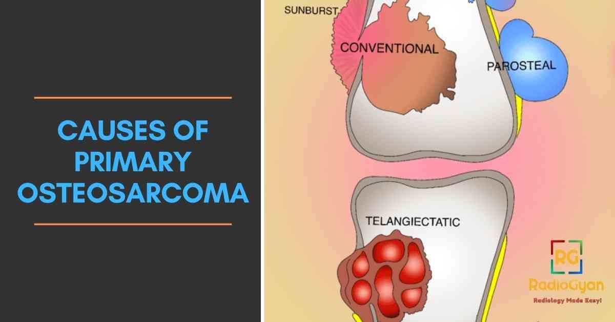 causes of Primary Osteosarcoma