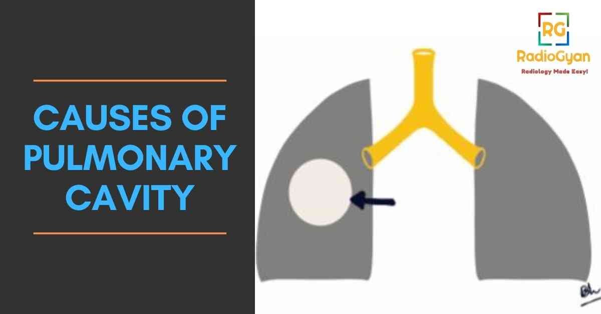causes of Pulmonary Cavity
