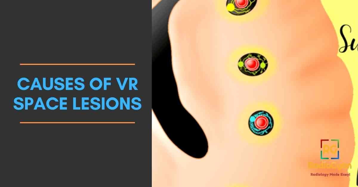 causes of VR Space Lesions
