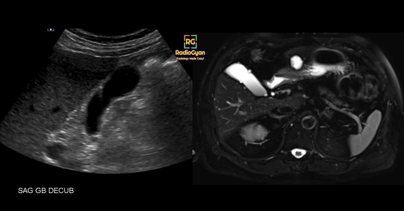 Ultrasound and MRI image showing gallbladder adenomyomatosis 