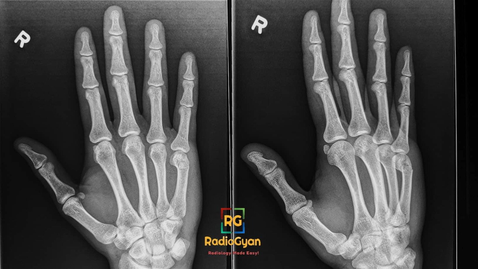 Radiograph showing Boxer's fracture after punch to a wall