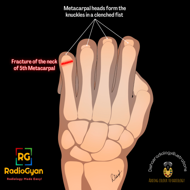 Boxer's fracture clinical illustration of mechanism of injury