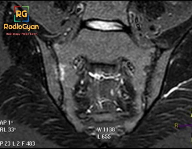 MRI STIR Image showing subchondral bone marrow edema in Sacroilitis