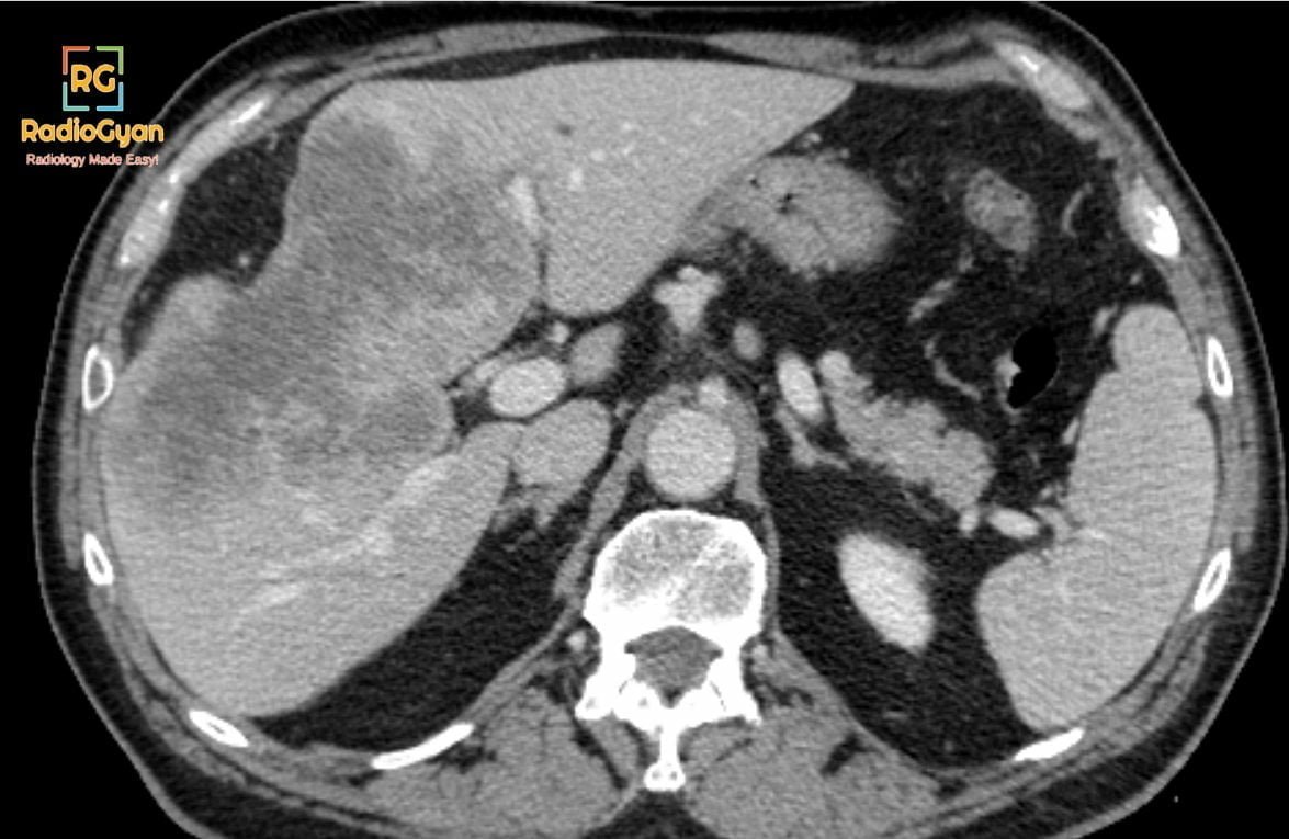 Mass forming cholangiocarcinoma CT Image showing capsular retraction