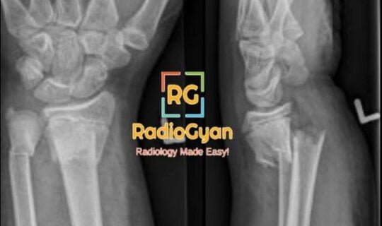 Frontal and lateral radiographs showing Colle fracture radius