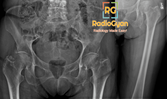 Left femoral subcapital fracture radiograph
