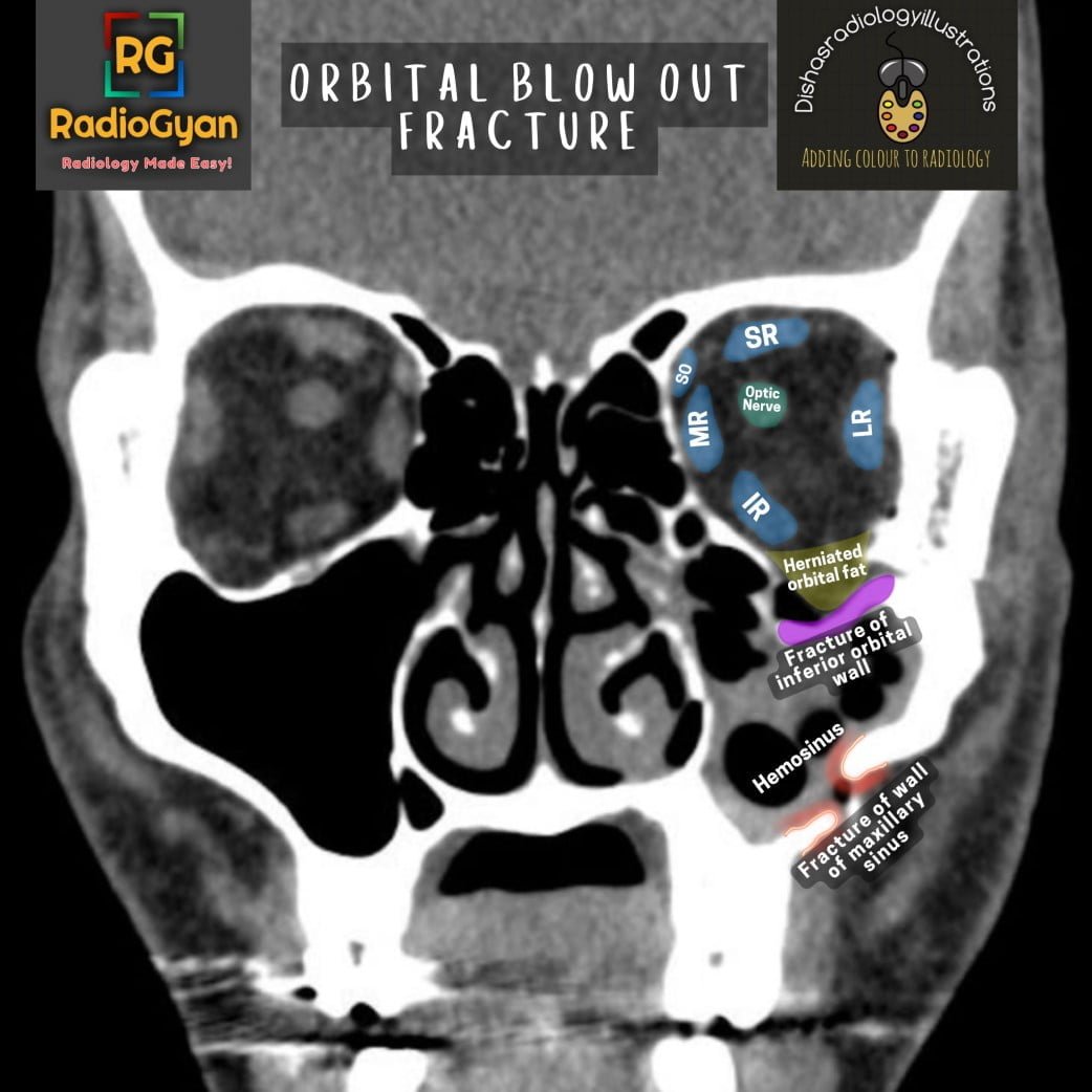 Left orbit blow out fracture CT with anatomy illustration