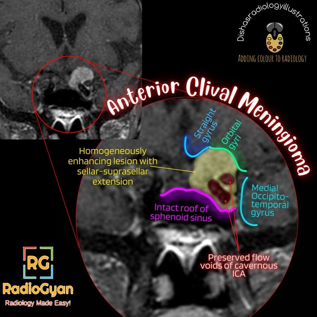 Illustration showing an anterior clival meningioma