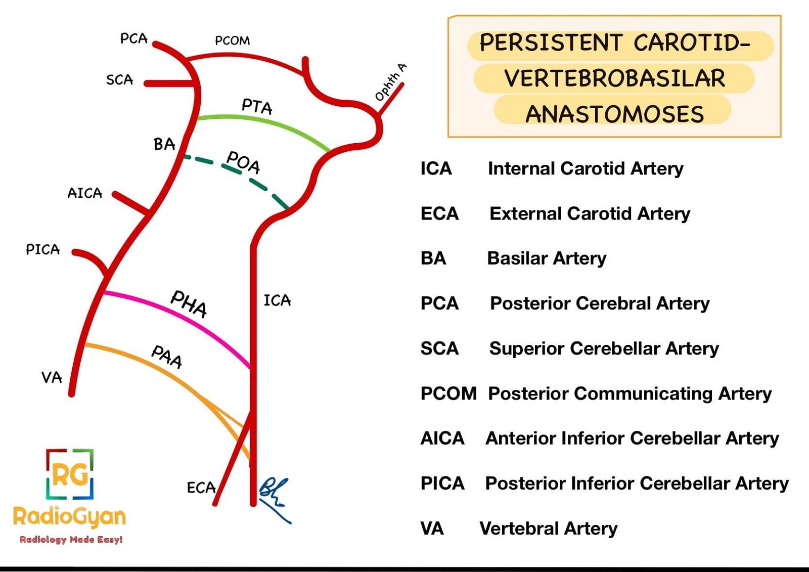 Illustration showing persistent carotid-vertebrobasilar anastomoses