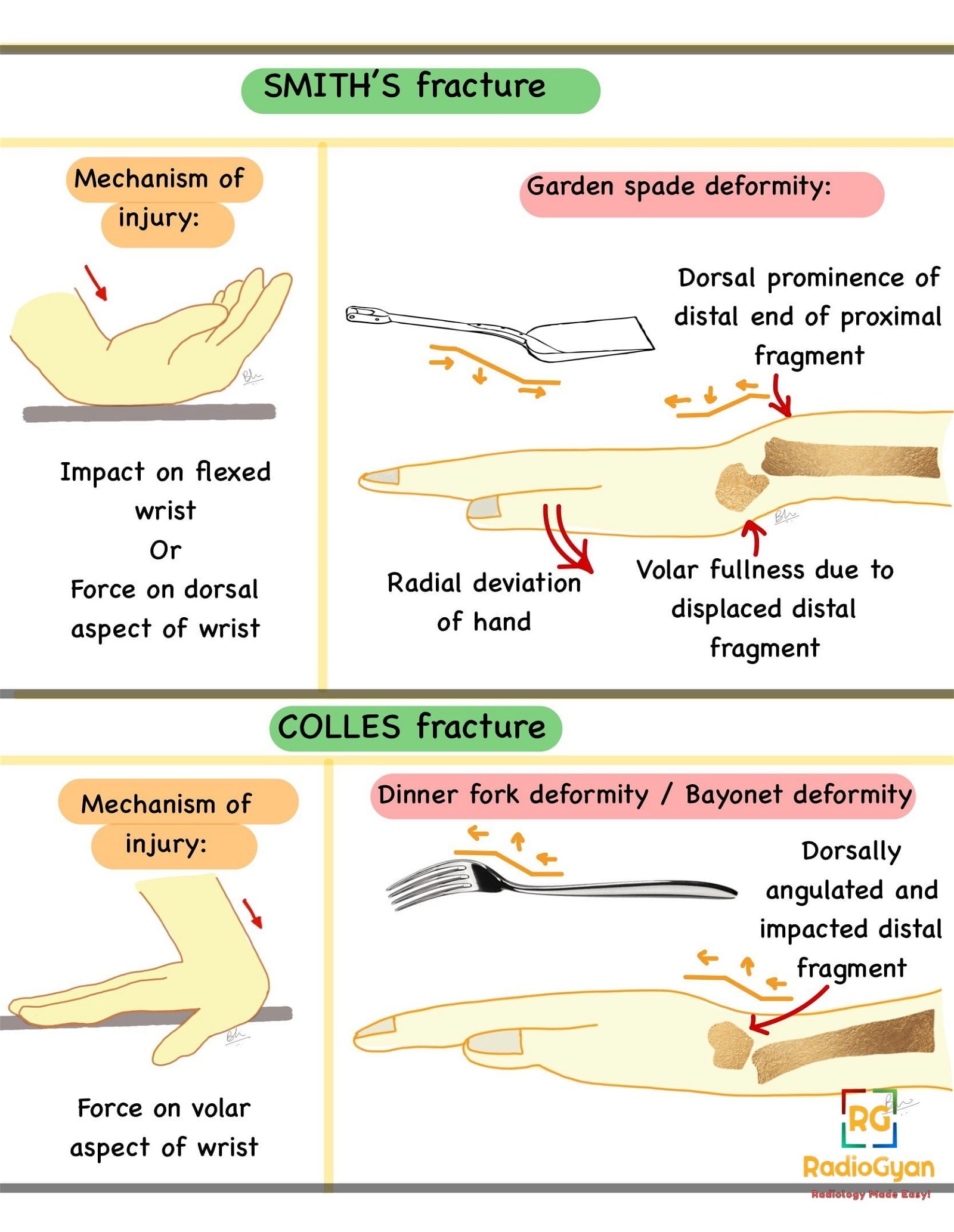 Distal Radial Fracture Radiology Case