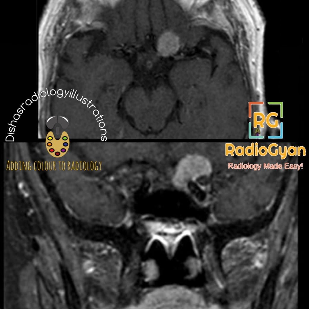 Meningioma Radiology Case