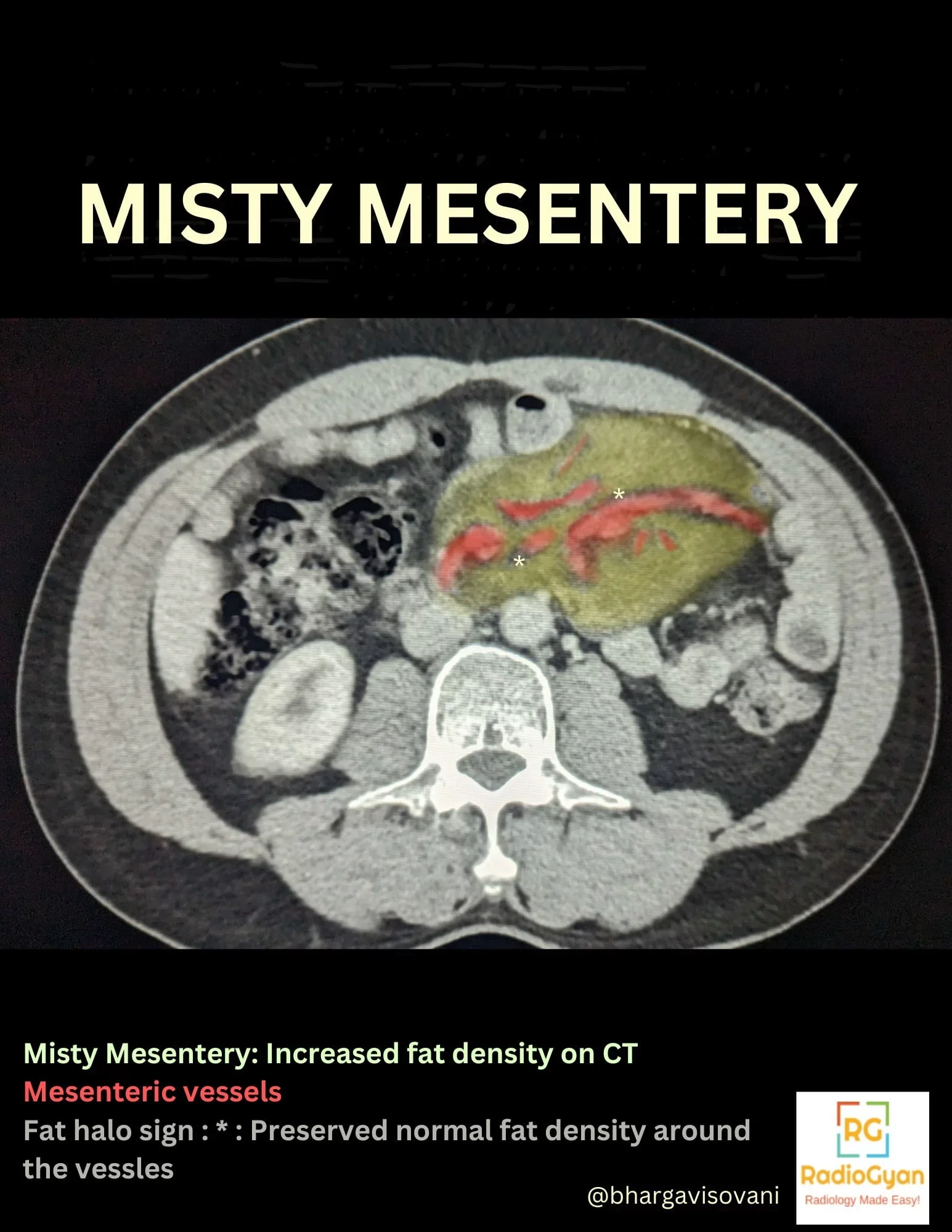 Misty Mesentery Radiology Case