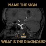 Persistent Trigeminal Artery Radiology Case