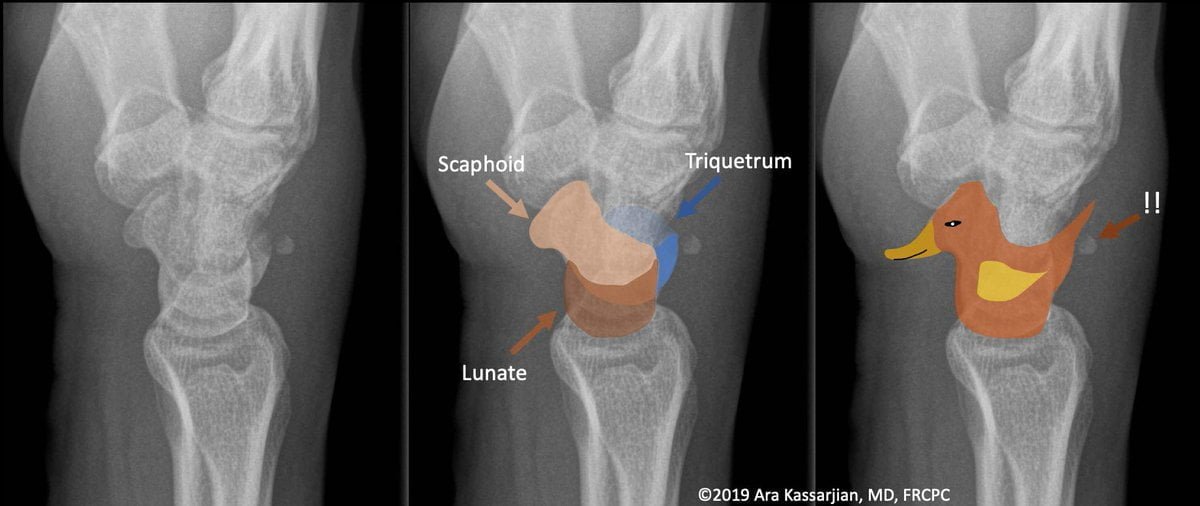 Pooping Duck Sign Dorsal Triquetral fracture