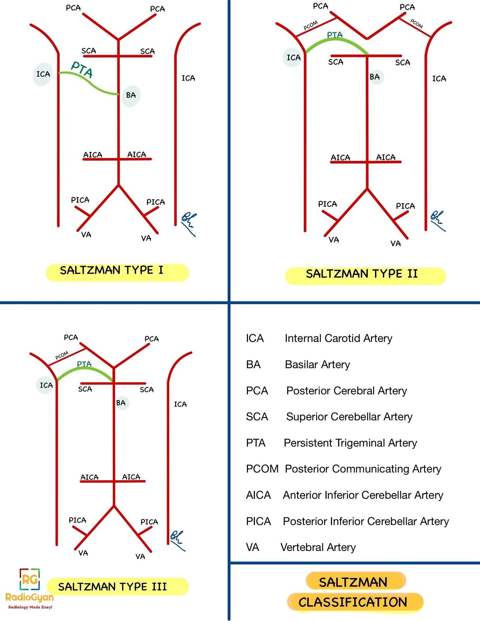 Saltzman Classification System for persistent carotid-vertebrobasilar anastomoses