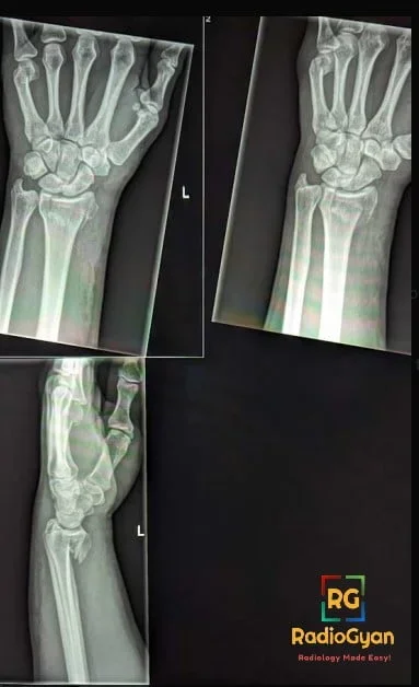 Colle Fracture - Distal Radial Fracture, Radiology Case
