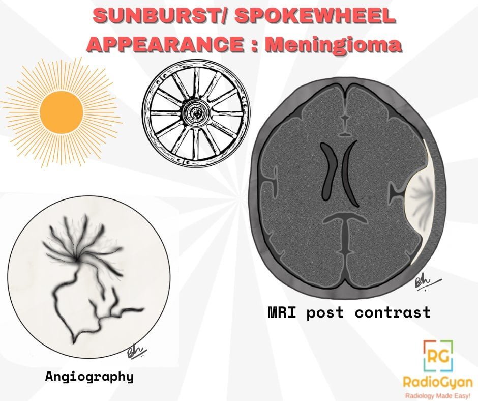 Sunburst-spoke wheel appearance in meningiomas