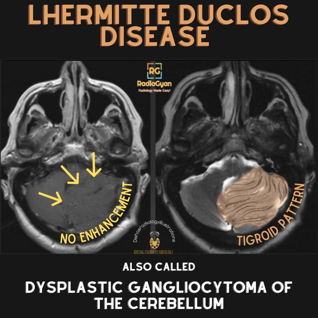 Tigroid pattern on MRI in Lhermitte-Duclos disease