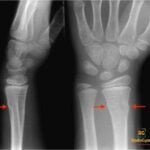 Torus Fracture Radiology Case